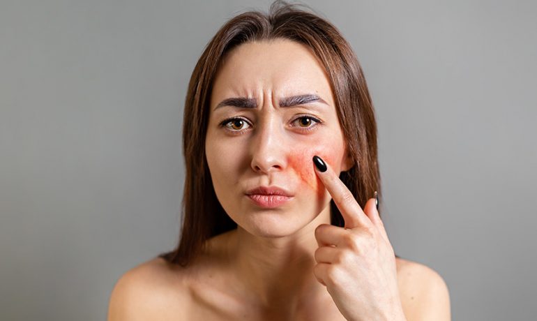 “Micro-Botox/Dysport” for flushing, pore size, etc.
