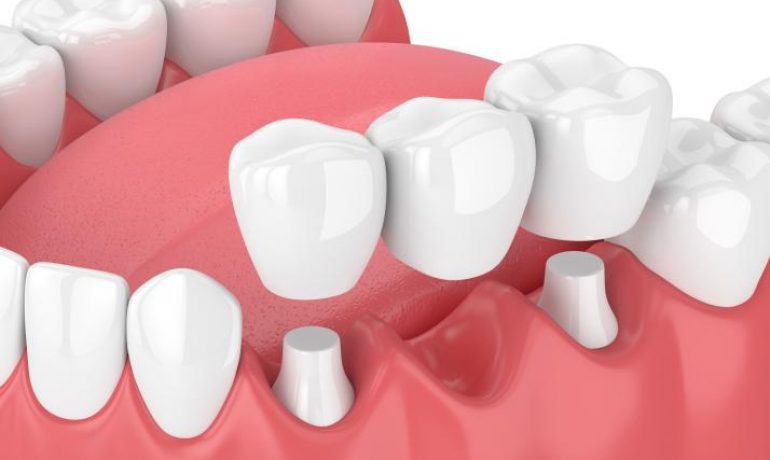 Dental Bridges Crowns