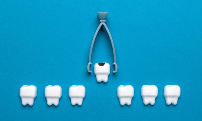 Wisdom Teeth Extraction in Dubai