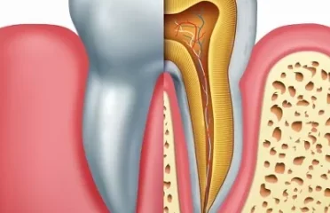 Root Canal in Dubai